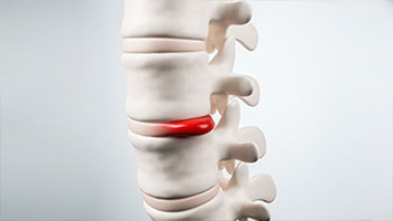 Disc Injuries Treatment Cupertino